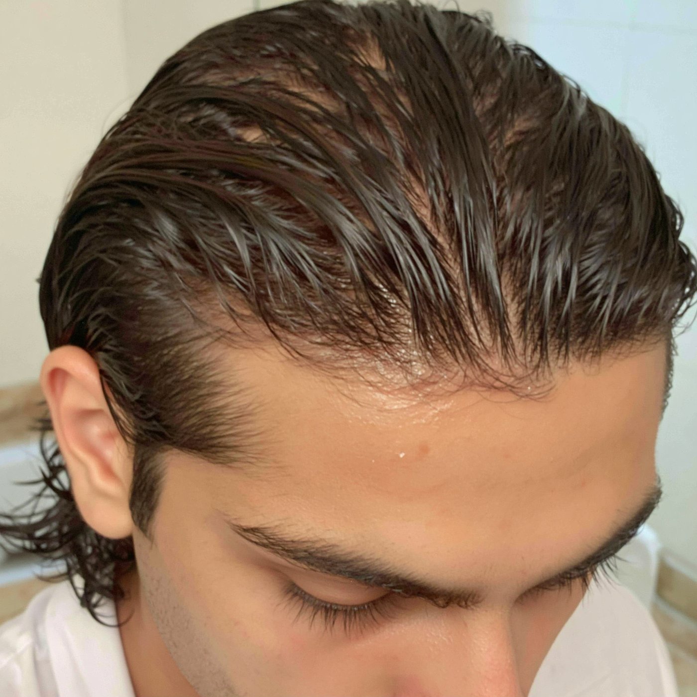Vista cercana del cuero cabelludo y línea de cabello de un hombre
